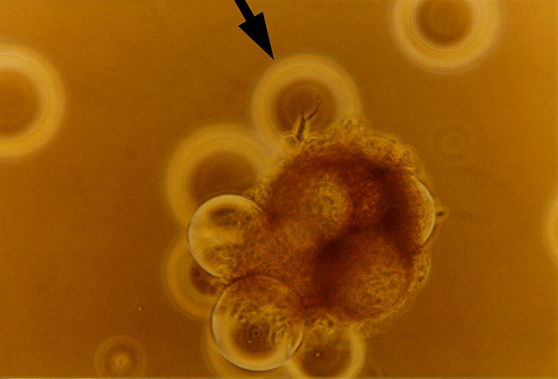 File:Breastcancercell.jpg