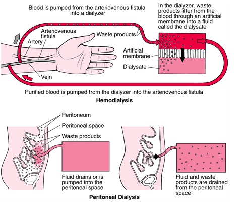 File:Peritoneal dialysis photo.jpg