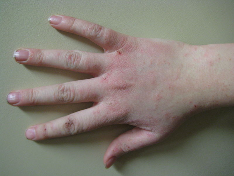 File:Human handwithdermatitis.jpg