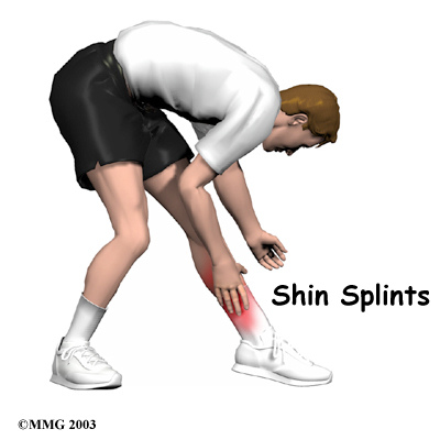 Shin Splints.jpg