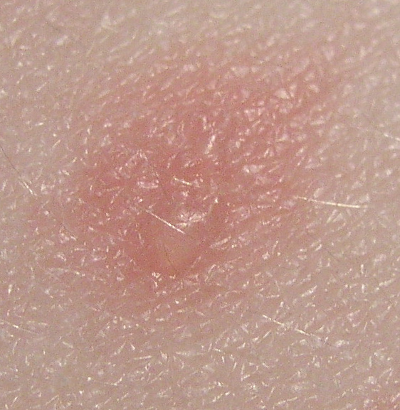 File:Blister.jpg
