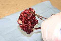 An image of squamous cell carcinoma after it has been removed