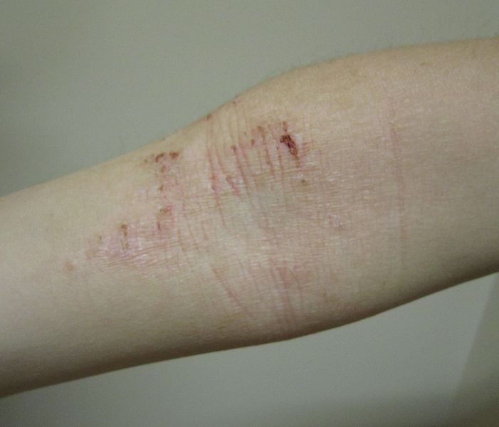 File:Atopic Dermatitis--arm.JPG