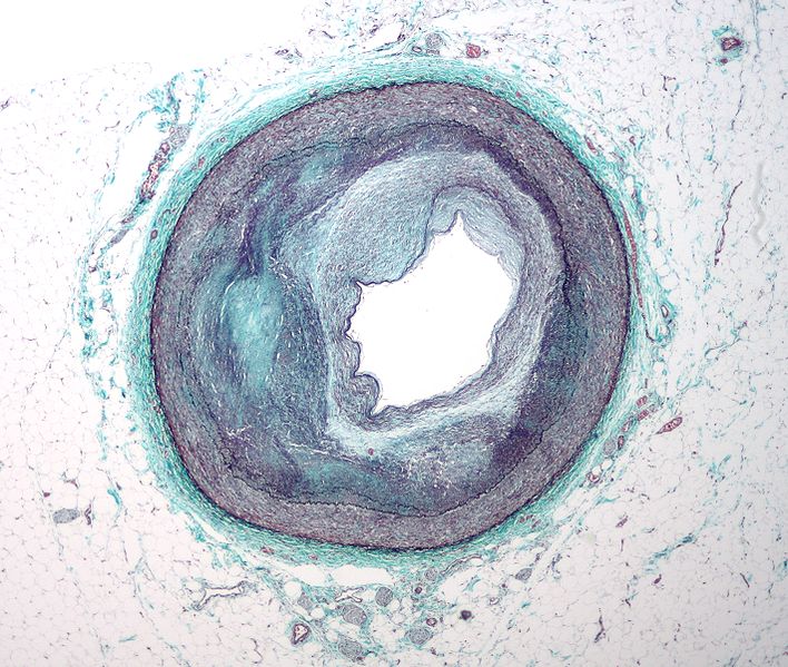 File:708px-RCA atherosclerosis.jpg