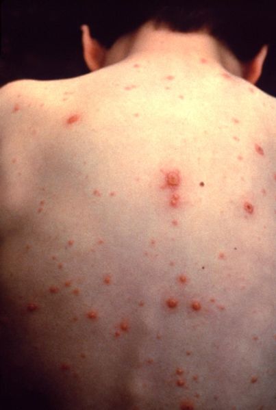 File:Varicella.jpg