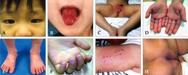 File:Kawasaki disease symtoms.jpg