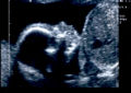 Sonogram of a baby at 20 weeks