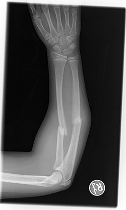 Broken Radius And Ulna.jpg