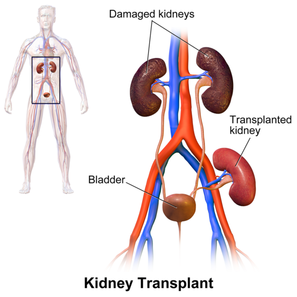 File:Kidney Transplant1.png