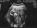 An ultrasound of a 15 week old fetus