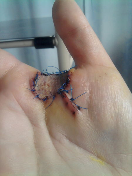 File:Skin graft.jpg