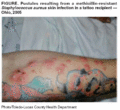 Staph infection in tattoo recipient resulting in pustules