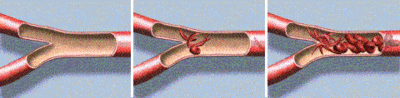 Sickled red blood cells clump together and block flow to blood vessels.