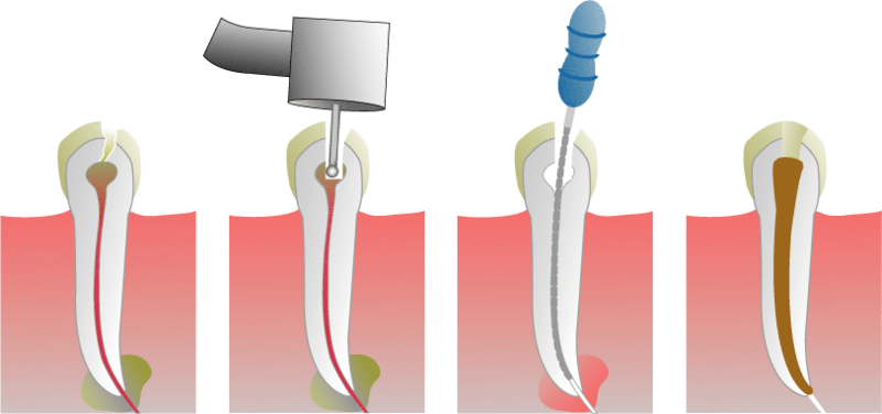 File:Root Canal Illustration.png