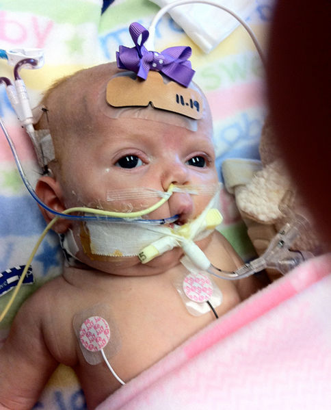File:Pertussis-baby-one-lg.jpg