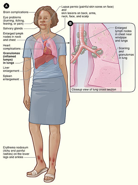 File:Sarcoidosis.jpg