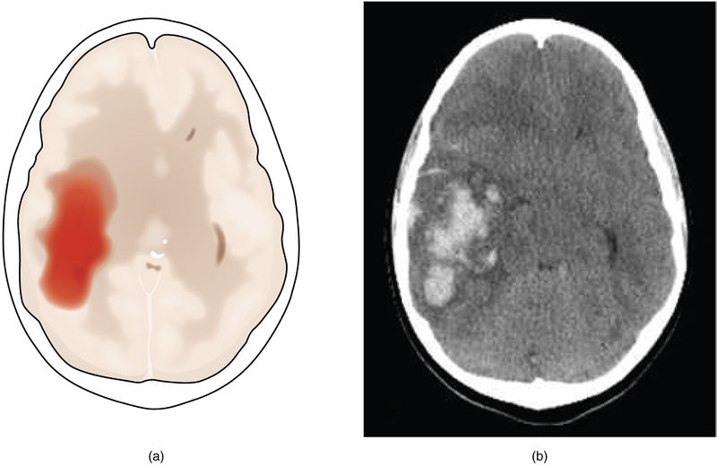 File:Brain Hemorrhage.jpg