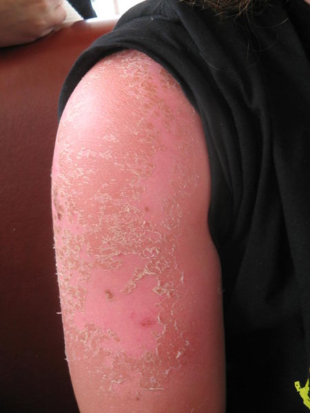 File:Sun burn.jpg