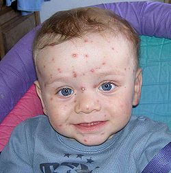 Chickenpox1.jpg
