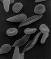 Misshapen red blood cells characteristic of sickle cell anemia.