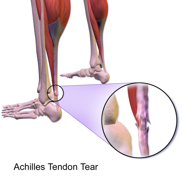 File:Achilles Tendon Tear.png