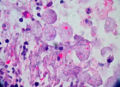 Amebic colitis: Amoebic dysentery - inflammation of the intestine with ulcers in the colon due to infection with an amoeba (Entamoeba histolytica) Class: Archamoebae.