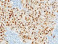 A biopsy of a lymph node from the lungs that has been infected with sarcoidosis.