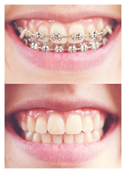 File:Braces .jpg