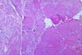 Polio type 3 in muscle tissue