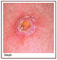 Staph infection (Staphylococcus ) Aureus