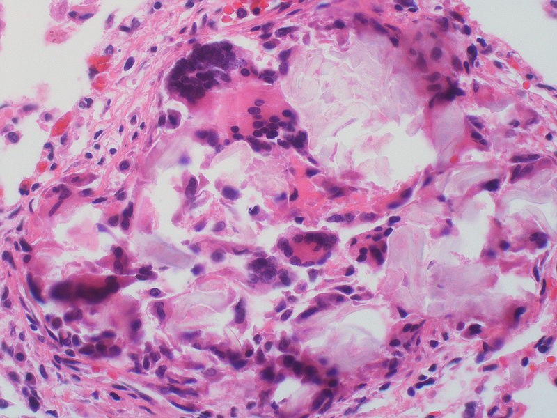 File:In artery.jpg