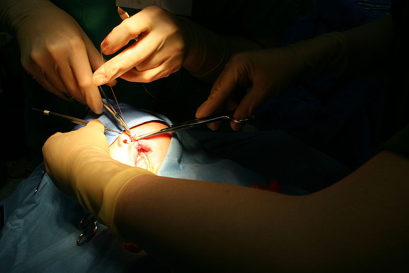 File:Surgery, cleft.jpg