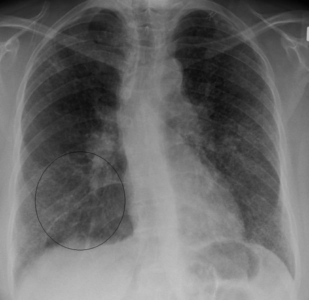 File:Sarcoidxray.png