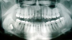 800px-Cyst - wisdom tooth.jpg