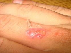 Burn injury.jpg