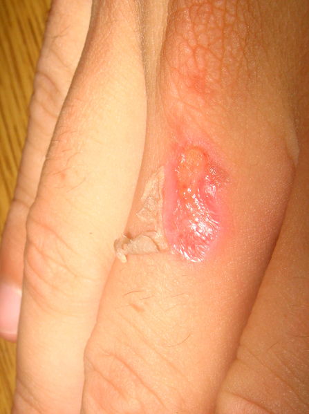 File:Burn injury.jpg