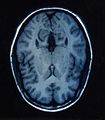 MRI of a Human Brain