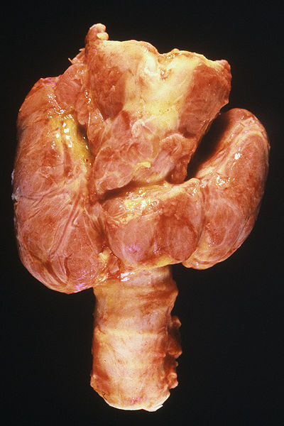 File:Thyroid2.jpg